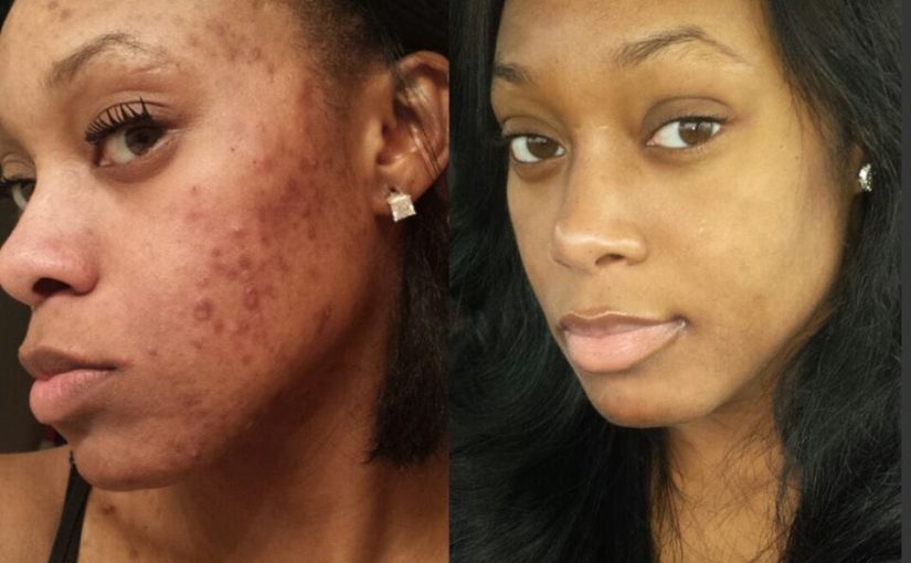 3 Myths of Acne – Part One